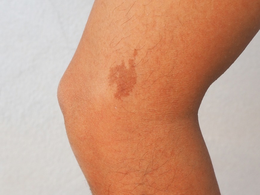 Birthmark treatment at Dr. Kamil Al Rustom Skin and Laser Centre Dubai Birthmark treatment at Dr. Kamil Al Rustom Skin and Laser Centre Dubai